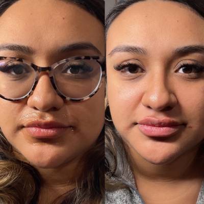 FILLERS